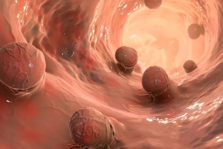 How Colon Polyp Size, Shape and Growth Pattern Affect Cancer Risk