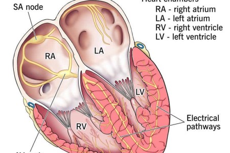 Junctional tachycardia