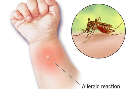 Skeeter Syndrome