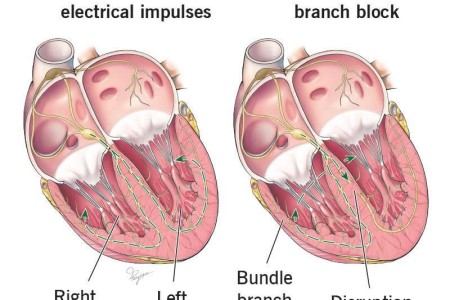 Left Bundle Branch Block