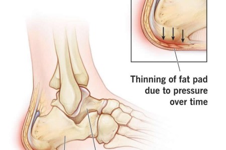 Heel Fat Pad Syndrome