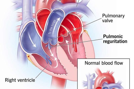 Pulmonic Valve Regurgitation