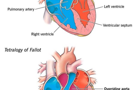 Overriding Aorta