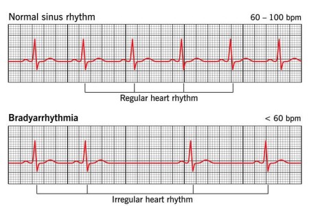 Bradyarrhythmia