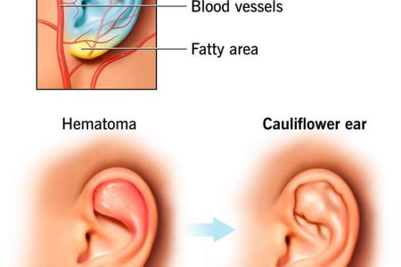 Cauliflower Ear