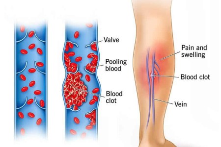 Thrombophlebitis
