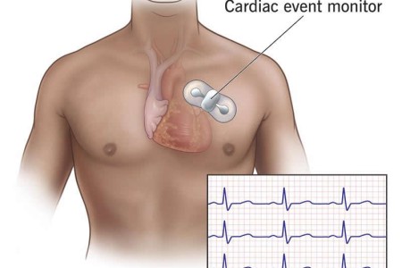 Cardiac Event Monitor (Heart Monitor)