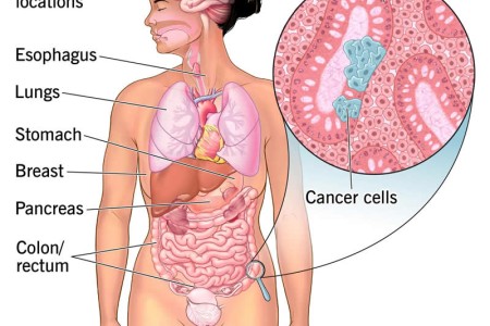 Carcinoma