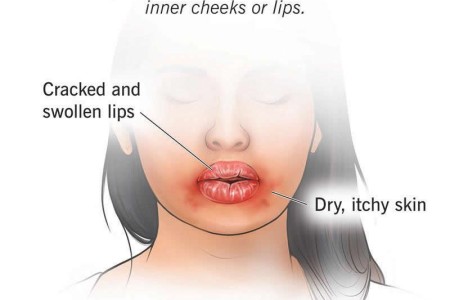 Orofacial Granulomatosis