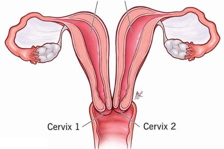 Uterus Didelphys