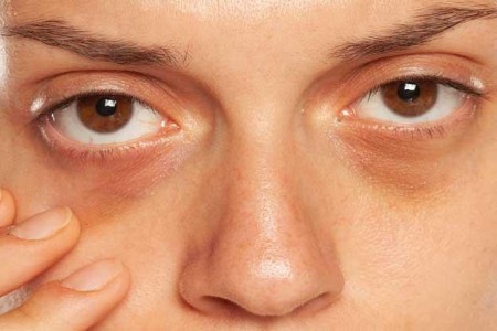 Dark Circles Under Eyes
