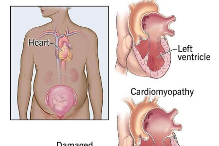 Peripartum Cardiomyopathy
