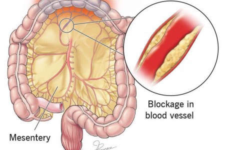 Mesenteric Ischemia
