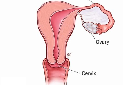 Unicornuate Uterus