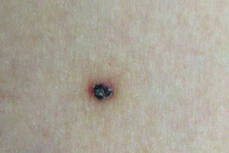 Angiokeratoma