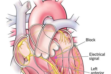 Left Anterior Fascicular Block