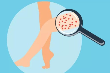 5 Ways To Get Rid of Strawberry Legs