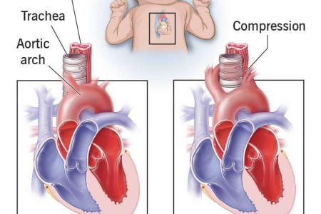 Double Aortic Arch