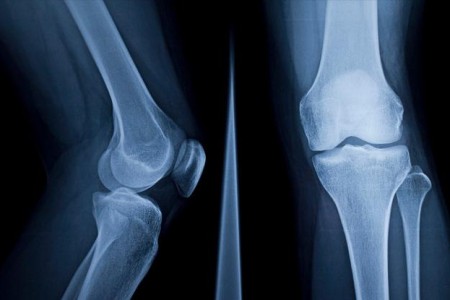 Knee X-Ray
