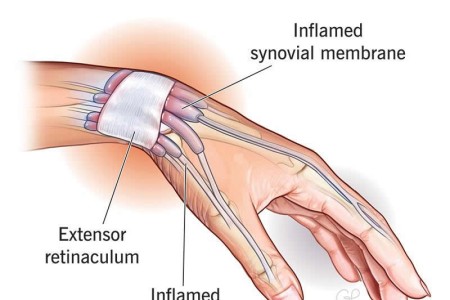 Tenosynovitis