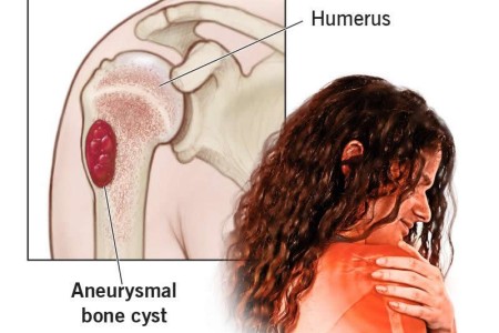 Aneurysmal Bone Cyst (ABC)