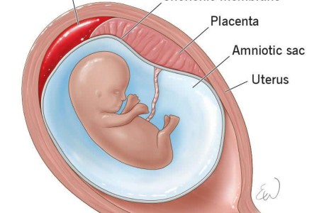 Subchorionic Hematoma