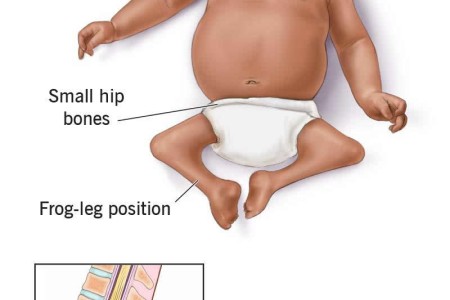 Caudal Regression Syndrome