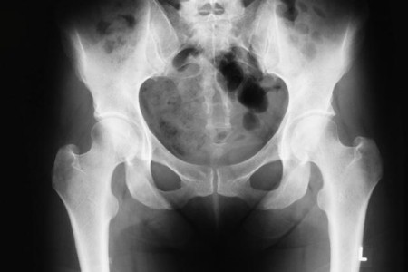 Pelvis X-Ray