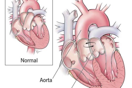 Transposition of the Great Arteries