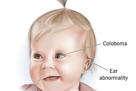 CHARGE Syndrome