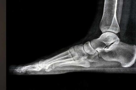 Foot X-Ray