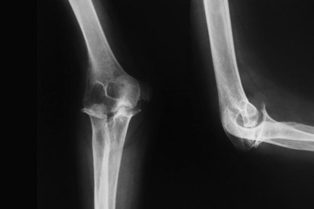 Elbow X-Ray