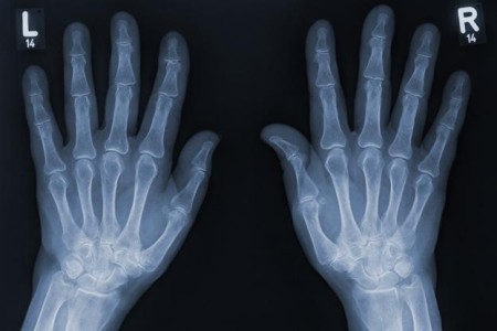 Hand X-Ray
