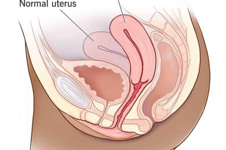 Retroverted Uterus
