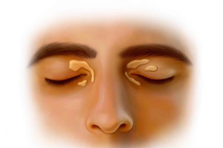 Xanthelasma