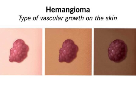 Hemangioma