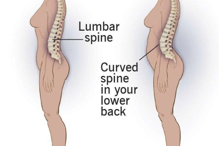 Lordosis (Swayback)