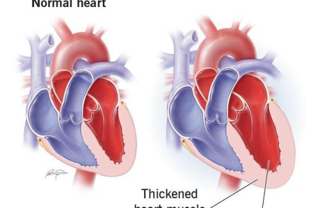 Athlete's Heart