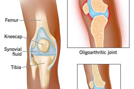 Oligoarthritis