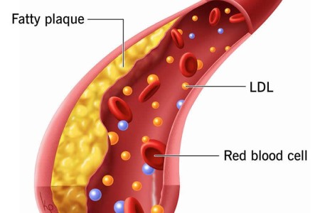 Hypercholesterolemia