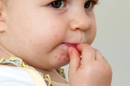 What To Know About Hand, Foot and Mouth Disease