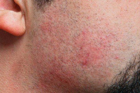Razor Burn