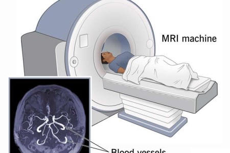 MRA (Magnetic Resonance Angiography)