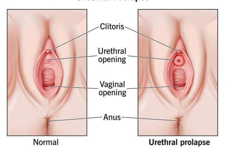 Urethral Prolapse