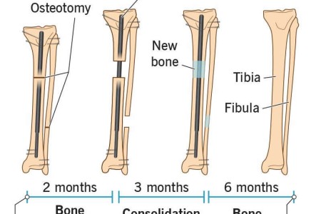 Limb Lengthening Surgery