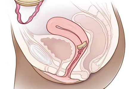 Birth Control Sponge