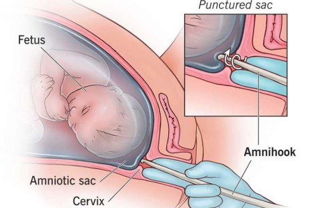 Amniotomy