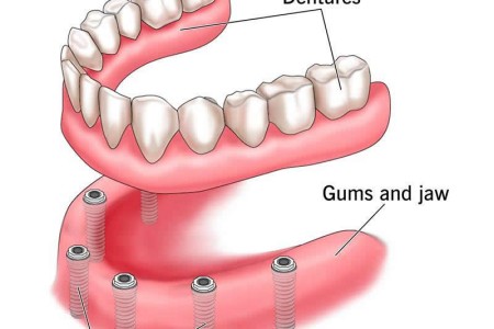 Implant-Supported Dentures