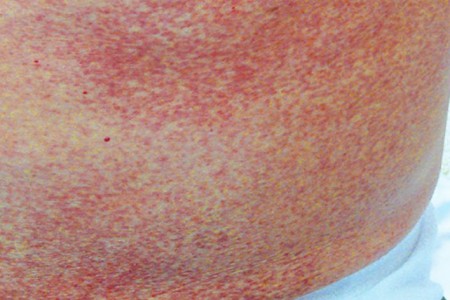 Systemic Mastocytosis