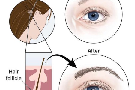 Eyebrow Transplant